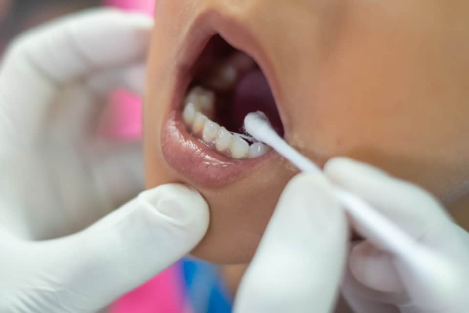 pediatric dentistry - Fluoride