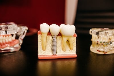 Dental Implant sculpture
